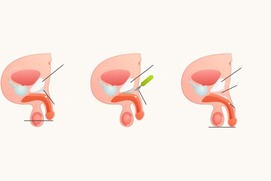 Ligamentotomy untuk meningkatkan zakar
