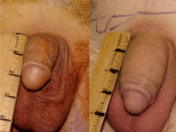 Sebelum dan selepas lipofilling dan implantasi gel